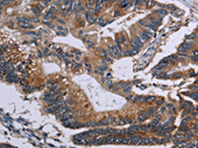 The image on the left is immunohistochemistry of paraffin-embedded Human colon cancer tissue using CSB-PA271638(CLDND1 Antibody) at dilution 1/50, on the right is treated with fusion protein. (Original magnification: ×200)