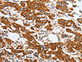 The image on the left is immunohistochemistry of paraffin-embedded Human breast cancer tissue using CSB-PA272079(MAPT Antibody) at dilution 1/20, on the right is treated with fusion protein. (Original magnification: ×200)