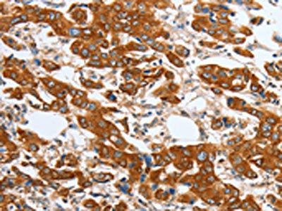 The image on the left is immunohistochemistry of paraffin-embedded Human breast cancer tissue using CSB-PA272079(MAPT Antibody) at dilution 1/20, on the right is treated with fusion protein. (Original magnification: ×200)
