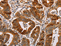 The image on the left is immunohistochemistry of paraffin-embedded Human gastic cancer tissue using CSB-PA272721(ALDH3A1 Antibody) at dilution 1/55, on the right is treated with fusion protein. (Original magnification: ×200)