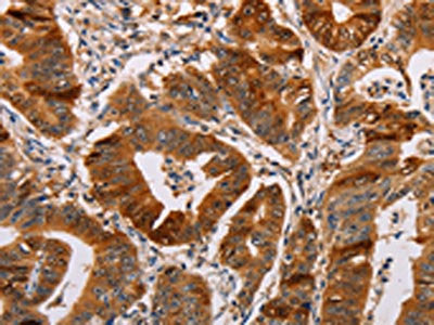 The image on the left is immunohistochemistry of paraffin-embedded Human gastic cancer tissue using CSB-PA272721(ALDH3A1 Antibody) at dilution 1/55, on the right is treated with fusion protein. (Original magnification: ×200)