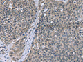The image on the left is immunohistochemistry of paraffin-embedded Human cervical cancer tissue using CSB-PA272939(FANCG Antibody) at dilution 1/30, on the right is treated with fusion protein. (Original magnification: ×200)