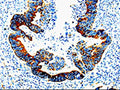 The image on the left is immunohistochemistry of paraffin-embedded Human rectal cancer tissue using CSB-PA273292(IL23R Antibody) at dilution 1/10, on the right is treated with fusion protein. (Original magnification: ×200)