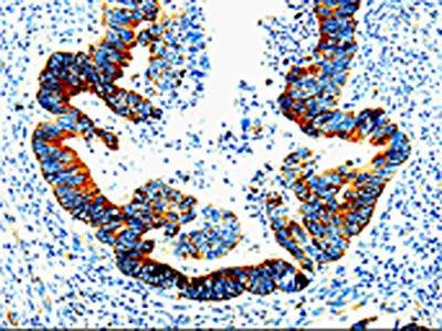 The image on the left is immunohistochemistry of paraffin-embedded Human rectal cancer tissue using CSB-PA273292(IL23R Antibody) at dilution 1/10, on the right is treated with fusion protein. (Original magnification: ×200)