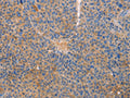 The image on the left is immunohistochemistry of paraffin-embedded Human liver cancer tissue using CSB-PA273344(CXCL3 Antibody) at dilution 1/20, on the right is treated with fusion protein. (Original magnification: ×200)