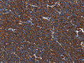 The image on the left is immunohistochemistry of paraffin-embedded Human lymphoma tissue using CSB-PA273685(PLK3 Antibody) at dilution 1/40, on the right is treated with fusion protein. (Original magnification: ×200)