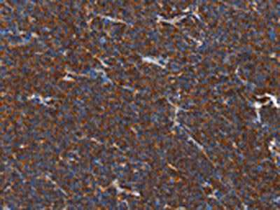 The image on the left is immunohistochemistry of paraffin-embedded Human lymphoma tissue using CSB-PA273685(PLK3 Antibody) at dilution 1/40, on the right is treated with fusion protein. (Original magnification: ×200)