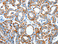 The image on the left is immunohistochemistry of paraffin-embedded Human thyroid cancer tissue using CSB-PA273719(ALDH5A1 Antibody) at dilution 1/60, on the right is treated with synthetic peptide. (Original magnification: ×200)