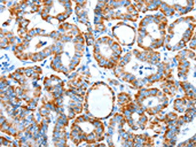 The image on the left is immunohistochemistry of paraffin-embedded Human thyroid cancer tissue using CSB-PA273719(ALDH5A1 Antibody) at dilution 1/60, on the right is treated with synthetic peptide. (Original magnification: ×200)