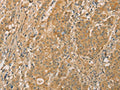 The image on the left is immunohistochemistry of paraffin-embedded Human gastic cancer tissue using CSB-PA273741(SNAP91 Antibody) at dilution 1/20, on the right is treated with fusion protein. (Original magnification: ×200)