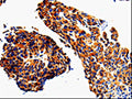 The image on the left is immunohistochemistry of paraffin-embedded Human lung cancer tissue using CSB-PA274173(ADD1 Antibody) at dilution 1/50, on the right is treated with fusion protein. (Original magnification: ×200)