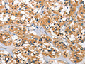 The image on the left is immunohistochemistry of paraffin-embedded Human thyroid cancer tissue using CSB-PA274333(DKK3 Antibody) at dilution 1/30, on the right is treated with fusion protein. (Original magnification: ×200)