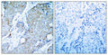 Immunohistochemical analysis of paraffin-embedded human breast carcinoma tissue using VEGFR2(Ab-1214) Antibody(left) or the same antibody preincubated with blocking peptide(right).
