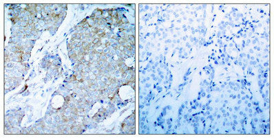 Immunohistochemical analysis of paraffin-embedded human breast carcinoma tissue using VEGFR2(Ab-1214) Antibody(left) or the same antibody preincubated with blocking peptide(right).