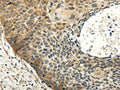 The image on the left is immunohistochemistry of paraffin-embedded Human esophagus cancer tissue using CSB-PA274413(ABCB7 Antibody) at dilution 1/20, on the right is treated with fusion protein. (Original magnification: ×200)