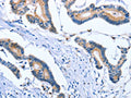 The image on the left is immunohistochemistry of paraffin-embedded Human colon cancer tissue using CSB-PA275027(PLK3 Antibody) at dilution 1/30, on the right is treated with fusion protein. (Original magnification: ×200)