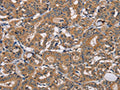 The image on the left is immunohistochemistry of paraffin-embedded Human thyroid cancer tissue using CSB-PA275058(TRAFD1 Antibody) at dilution 1/20, on the right is treated with fusion protein. (Original magnification: ×200)