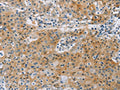 The image on the left is immunohistochemistry of paraffin-embedded Human gastic cancer tissue using CSB-PA275132(KCNMA1 Antibody) at dilution 1/40, on the right is treated with fusion protein. (Original magnification: ×200)