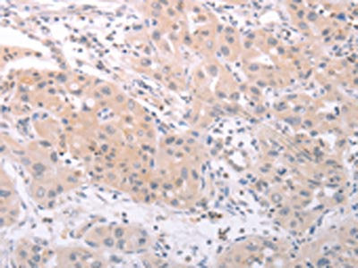 The image on the left is immunohistochemistry of paraffin-embedded Human lung cancer tissue using CSB-PA275207(SPATA16 Antibody) at dilution 1/25, on the right is treated with fusion protein. (Original magnification: ×200)