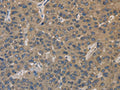 The image on the left is immunohistochemistry of paraffin-embedded Human liver cancer tissue using CSB-PA276232(EMC8 Antibody) at dilution 1/30, on the right is treated with fusion protein. (Original magnification: ×200)
