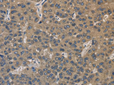 The image on the left is immunohistochemistry of paraffin-embedded Human liver cancer tissue using CSB-PA276232(EMC8 Antibody) at dilution 1/30, on the right is treated with fusion protein. (Original magnification: ×200)