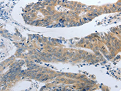 The image on the left is immunohistochemistry of paraffin-embedded Human colon cancer tissue using CSB-PA276678(SLC5A5 Antibody) at dilution 1/30, on the right is treated with synthetic peptide. (Original magnification: ×200)