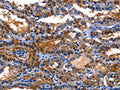 The image on the left is immunohistochemistry of paraffin-embedded Human thyroid cancer tissue using CSB-PA276679(LGALS8 Antibody) at dilution 1/10, on the right is treated with fusion protein. (Original magnification: ×200)