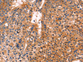 The image is immunohistochemistry of paraffin-embedded Human liver cancer tissue using CSB-PA276953(ANTXR1 Antibody) at dilution 1/25. (Original magnification: ×200)