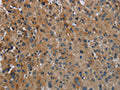 The image on the left is immunohistochemistry of paraffin-embedded Human liver cancer tissue using CSB-PA277783(FAAH Antibody) at dilution 1/50, on the right is treated with fusion protein. (Original magnification: ×200)