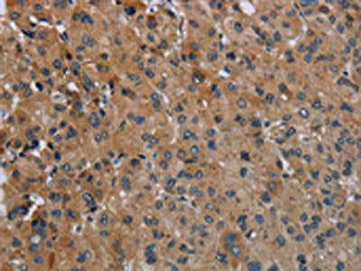 The image on the left is immunohistochemistry of paraffin-embedded Human liver cancer tissue using CSB-PA277783(FAAH Antibody) at dilution 1/50, on the right is treated with fusion protein. (Original magnification: ×200)