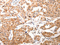 The image on the left is immunohistochemistry of paraffin-embedded Human ovarian cancer tissue using CSB-PA277795(BGLAP Antibody) at dilution 1/60, on the right is treated with synthetic peptide. (Original magnification: ×200)