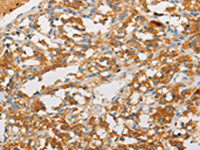 The image on the left is immunohistochemistry of paraffin-embedded Human thyroid cancer tissue using CSB-PA278026(ART3 Antibody) at dilution 1/40, on the right is treated with fusion protein. (Original magnification: ×200)