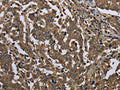 The image on the left is immunohistochemistry of paraffin-embedded Human liver cancer tissue using CSB-PA278921(GOLGA2 Antibody) at dilution 1/60, on the right is treated with fusion protein. (Original magnification: ×200)