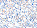 The image on the left is immunohistochemistry of paraffin-embedded Human thyroid cancer tissue using CSB-PA279017(ACSM5 Antibody) at dilution 1/35, on the right is treated with fusion protein. (Original magnification: ×200)