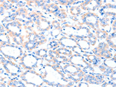 The image on the left is immunohistochemistry of paraffin-embedded Human thyroid cancer tissue using CSB-PA279017(ACSM5 Antibody) at dilution 1/35, on the right is treated with fusion protein. (Original magnification: ×200)