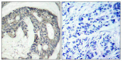 Immunohistochemical analysis of paraffin-embedded human breast carcinoma tissue using eNOS(Phospho-Ser1177) Antibody(left) or the same antibody preincubated with blocking peptide(right).