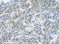The image on the left is immunohistochemistry of paraffin-embedded Human liver cancer tissue using CSB-PA279988(VLDLR Antibody) at dilution 1/35, on the right is treated with synthetic peptide. (Original magnification: ×200)