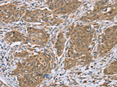 The image on the left is immunohistochemistry of paraffin-embedded Human cervical cancer tissue using CSB-PA280050(RNF139 Antibody) at dilution 1/35, on the right is treated with synthetic peptide. (Original magnification: ×200)
