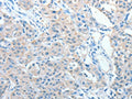 The image on the left is immunohistochemistry of paraffin-embedded Human lung cancer tissue using CSB-PA280169(AKAP9 Antibody) at dilution 1/10, on the right is treated with fusion protein. (Original magnification: ×200)