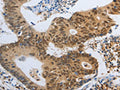 The image on the left is immunohistochemistry of paraffin-embedded Human colon cancer tissue using CSB-PA280193(POU2F2 Antibody) at dilution 1/40, on the right is treated with fusion protein. (Original magnification: ×200)