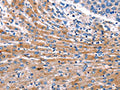 The image on the left is immunohistochemistry of paraffin-embedded Human liver cancer tissue using CSB-PA280305(CDK5 Antibody) at dilution 1/10, on the right is treated with fusion protein. (Original magnification: ×200)