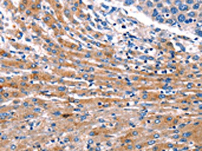 The image on the left is immunohistochemistry of paraffin-embedded Human liver cancer tissue using CSB-PA280305(CDK5 Antibody) at dilution 1/10, on the right is treated with fusion protein. (Original magnification: ×200)