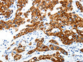 The image on the left is immunohistochemistry of paraffin-embedded Human lung cancer tissue using CSB-PA281021(ABI3BP Antibody) at dilution 1/25, on the right is treated with synthetic peptide. (Original magnification: ×200)