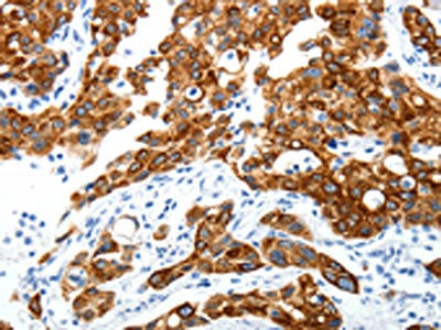 The image on the left is immunohistochemistry of paraffin-embedded Human lung cancer tissue using CSB-PA281021(ABI3BP Antibody) at dilution 1/25, on the right is treated with synthetic peptide. (Original magnification: ×200)