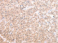 The image on the left is immunohistochemistry of paraffin-embedded Human esophagus cancer tissue using CSB-PA281213(TXN Antibody) at dilution 1/20, on the right is treated with synthetic peptide. (Original magnification: ×200)