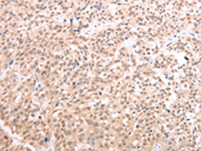 The image on the left is immunohistochemistry of paraffin-embedded Human esophagus cancer tissue using CSB-PA281213(TXN Antibody) at dilution 1/20, on the right is treated with synthetic peptide. (Original magnification: ×200)