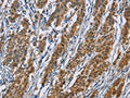 The image on the left is immunohistochemistry of paraffin-embedded Human gastic cancer tissue using CSB-PA281732(ACVR1 Antibody) at dilution 1/60, on the right is treated with fusion protein. (Original magnification: ×200)