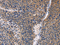 The image on the left is immunohistochemistry of paraffin-embedded Human liver cancer tissue using CSB-PA282230(PRKCD Antibody) at dilution 1/30, on the right is treated with fusion protein. (Original magnification: ×200)
