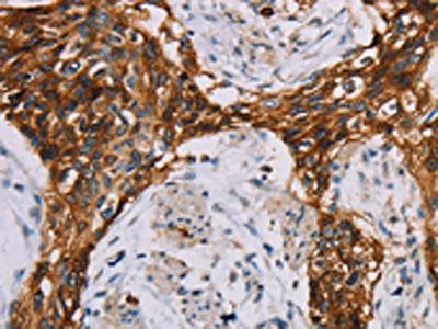 The image on the left is immunohistochemistry of paraffin-embedded Human esophagus cancer tissue using CSB-PA282285(CD44 Antibody) at dilution 1/35, on the right is treated with fusion protein. (Original magnification: ×200)