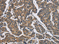The image on the left is immunohistochemistry of paraffin-embedded Human breast cancer tissue using CSB-PA283024(DHRS3 Antibody) at dilution 1/30, on the right is treated with fusion protein. (Original magnification: ×200)